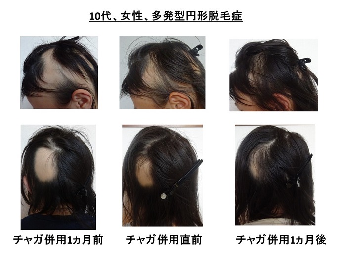 円形脱毛症　病院